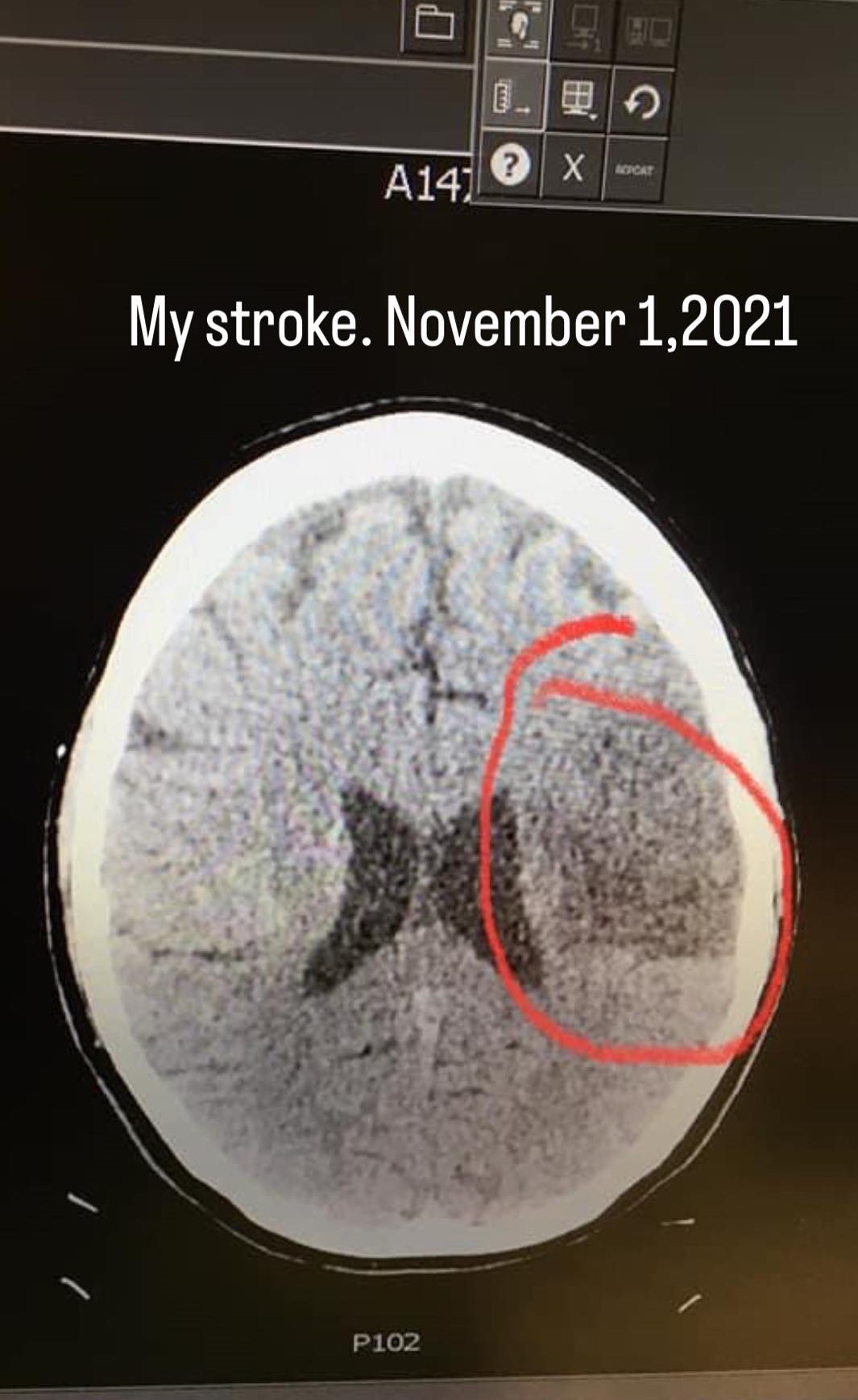 Life: Before and After Stroke.